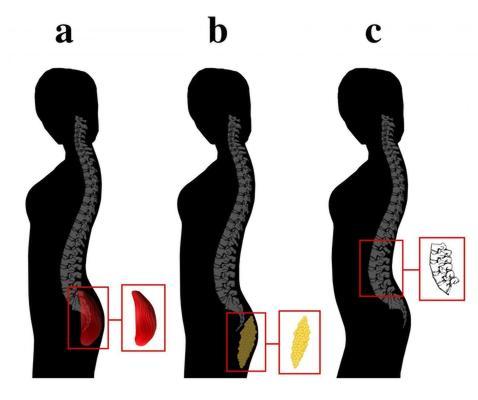 Protrusión de glúteos asociada con (a) el desarrollo de los glúteos, (b) el depósito de tejido adiposo, y (c), el acuñamiento vertebral