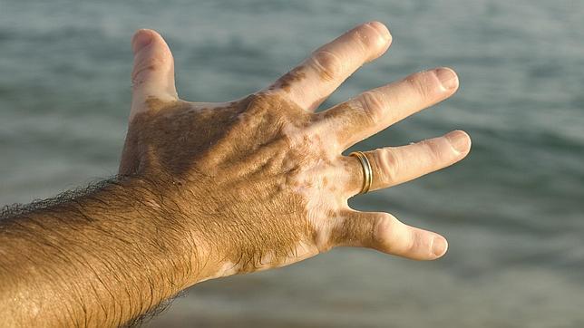 La mutación mediterránea que nos predispone al cáncer de piel