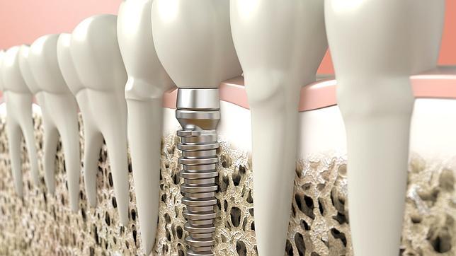 Los implantes dentales también deben cuidarse
