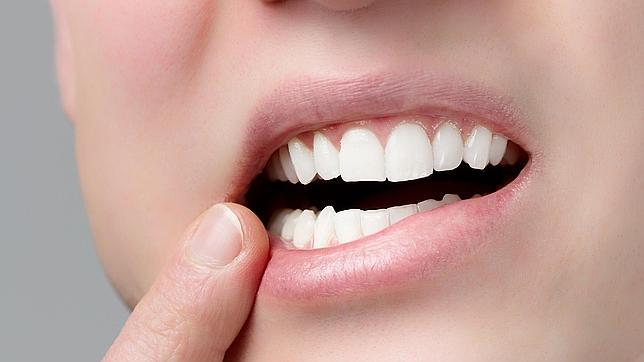 Un 25% de la población puede padecer hipersensibilidad dental