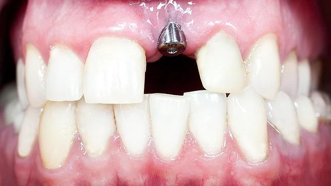 Implantes Dentales Todo Lo Que Debemos Saber