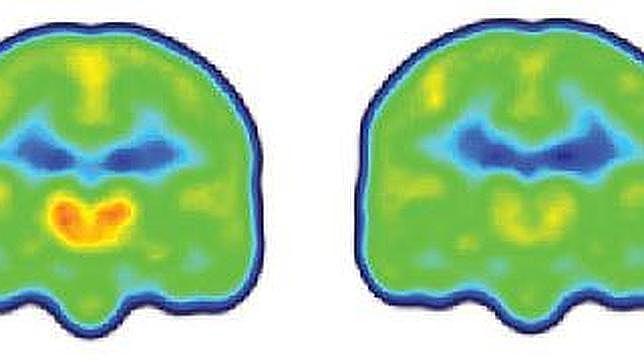 Visualización del dolor; a la izda un cerebro de una persona con dolor crónico donde se ve la activación de la proteína (naranja y rojo), y a la dcha el de una persona sana