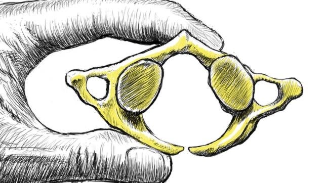 Primera vértebra cervical, llamada atlas, donde se aprecia la anomalía congénita del neandertal