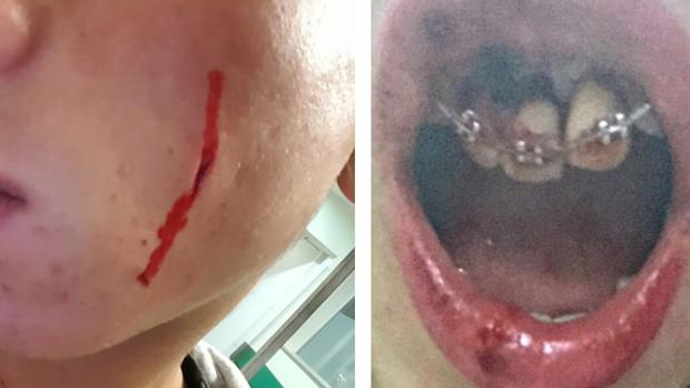 Las heridas en la boca de la joven