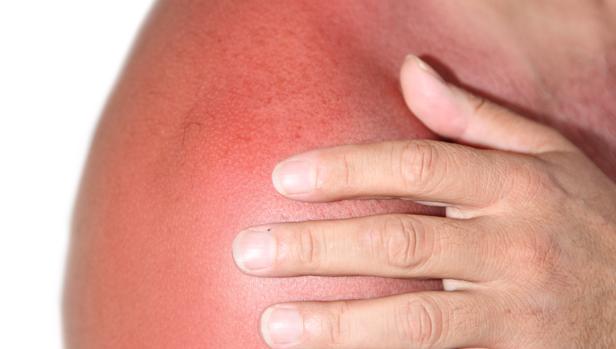 Echarse quemaduras de para sol que las