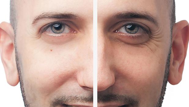 Un paciente tras someterse a un tratamiento con ácido hialurónico para rellenar las ojeras