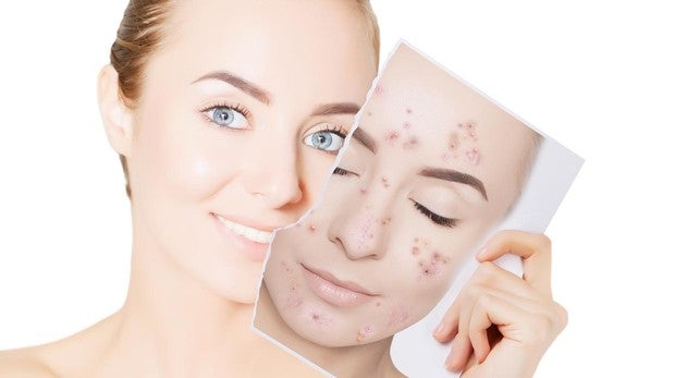 Sevilla acne tratamiento cicatrices