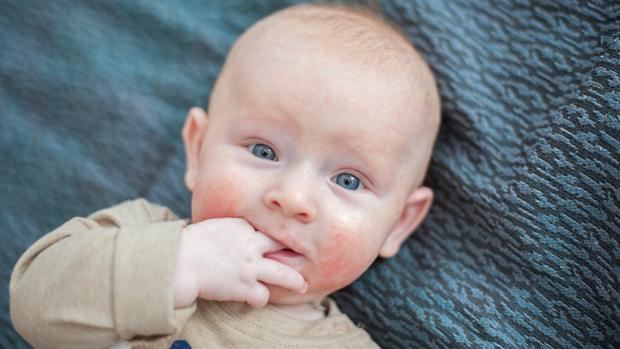 La dermatítis atópica puede condicionar la calidad de vida de los niños que la sufren