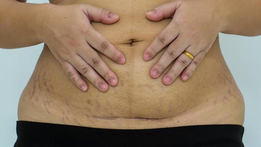 Cómo acabar con la diástasis abdominal (esto es, la tripa de la mujer