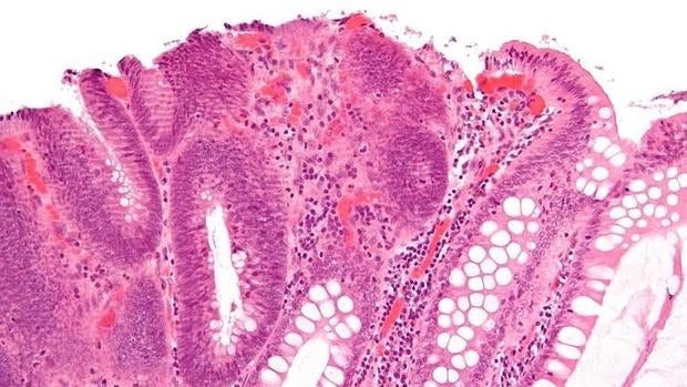Adenoma tubular precursor de cáncer colorrectal en paciente con PAF