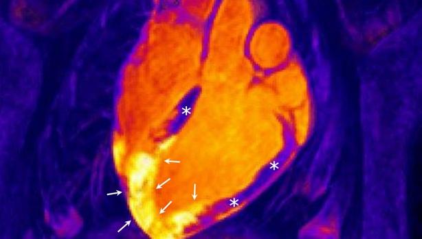 Fotos de corazon infartado