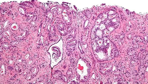 Cancer vesicula biliar histologia, Histologia diagnosticului de carcinom și prostată în minte