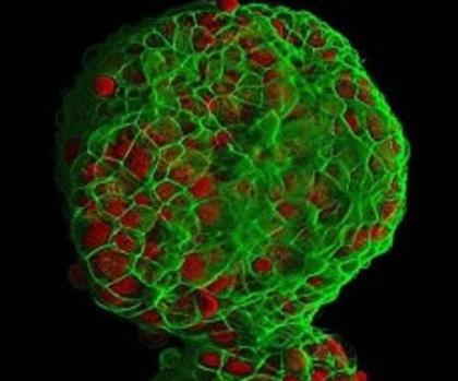 Cultivo tridimensional de células de cáncer de mama