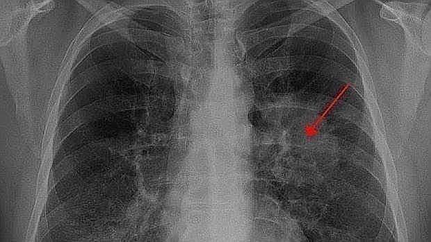 Radiografía para el éxito del cáncer de próstata
