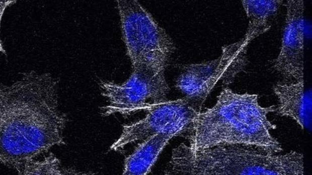 recurrencia del tratamiento del cáncer de próstata