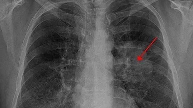 Radiografia de paciente con cáncer de pulmón