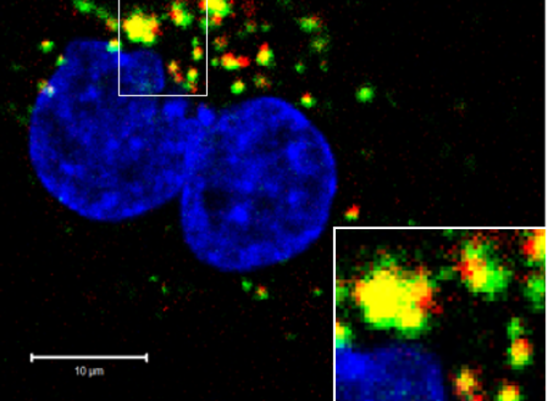 cáncer de próstata 7 etapa 14 cáncer de próstata 7 etapa 14