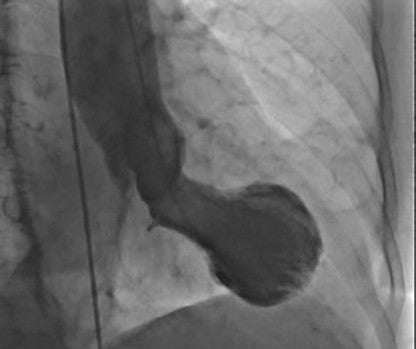Este es un corazón de Takotsubo, que muestra la forma típica que se asemeja a una trampa de pulpo japonesa.