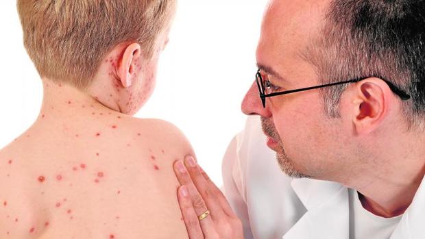 El sarampión ha resurgido en Europa por los movimientos antivacunas
