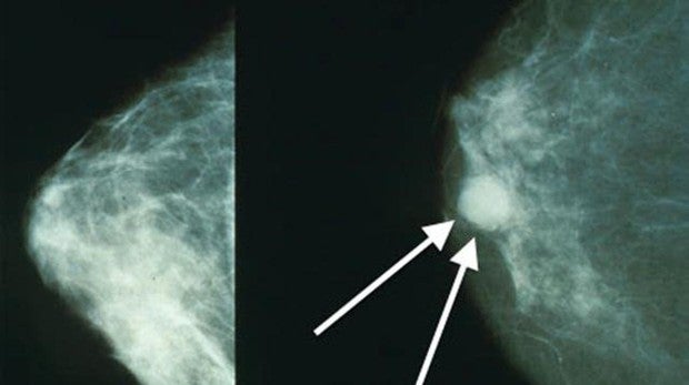 Detección precoz del cáncer de mama