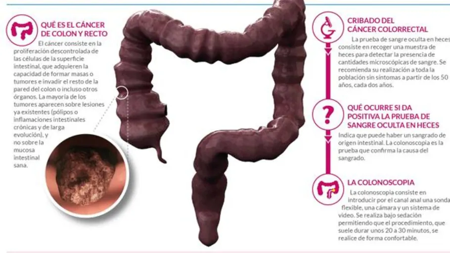 Cancer de prostata sintomas iniciales, Cancer de colon sintomas en mujeres