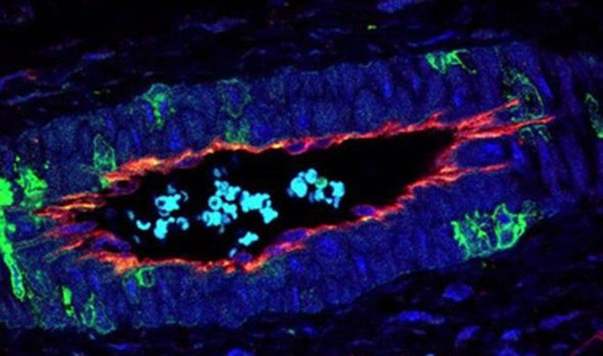 La proteína p38 regula la formación de nuevos vasos sanguíneos en tumores de cáncer de colon