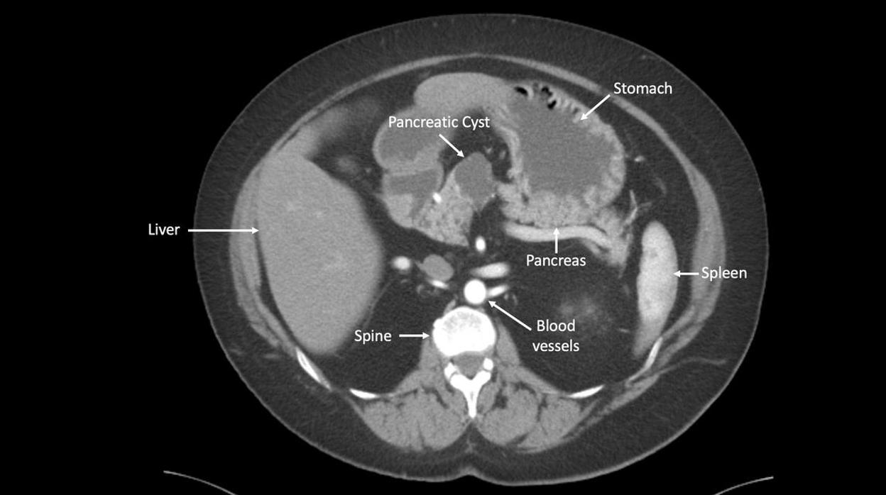 El trasplante fecal puede aumentar la supervivencia en pacientes con cáncer de páncreas