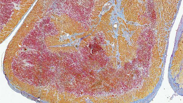 CorazÃ³n tras un infarto